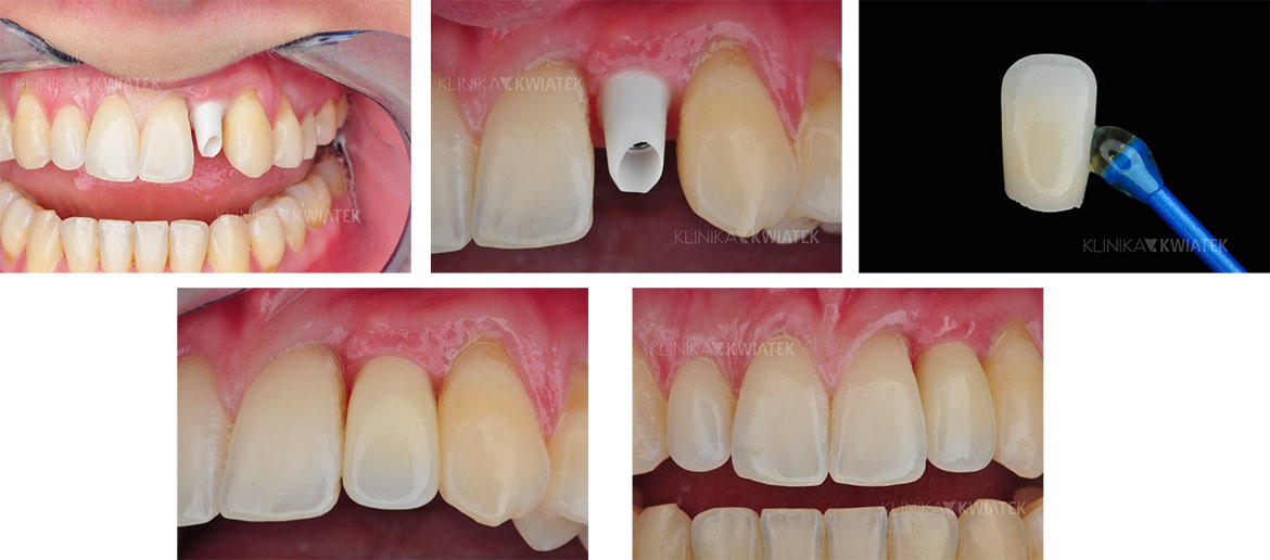 Crown attached to the implant using an individual connector - Execution by Kwiatek Clinic Poznań - Prosthetics