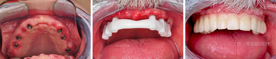 Prosthetic restoration in case of total tooth loss - 6 implants, Multi Unit connectors and 12 prosthetic crowns. Performed by Kwiatek Clinic Poznań.