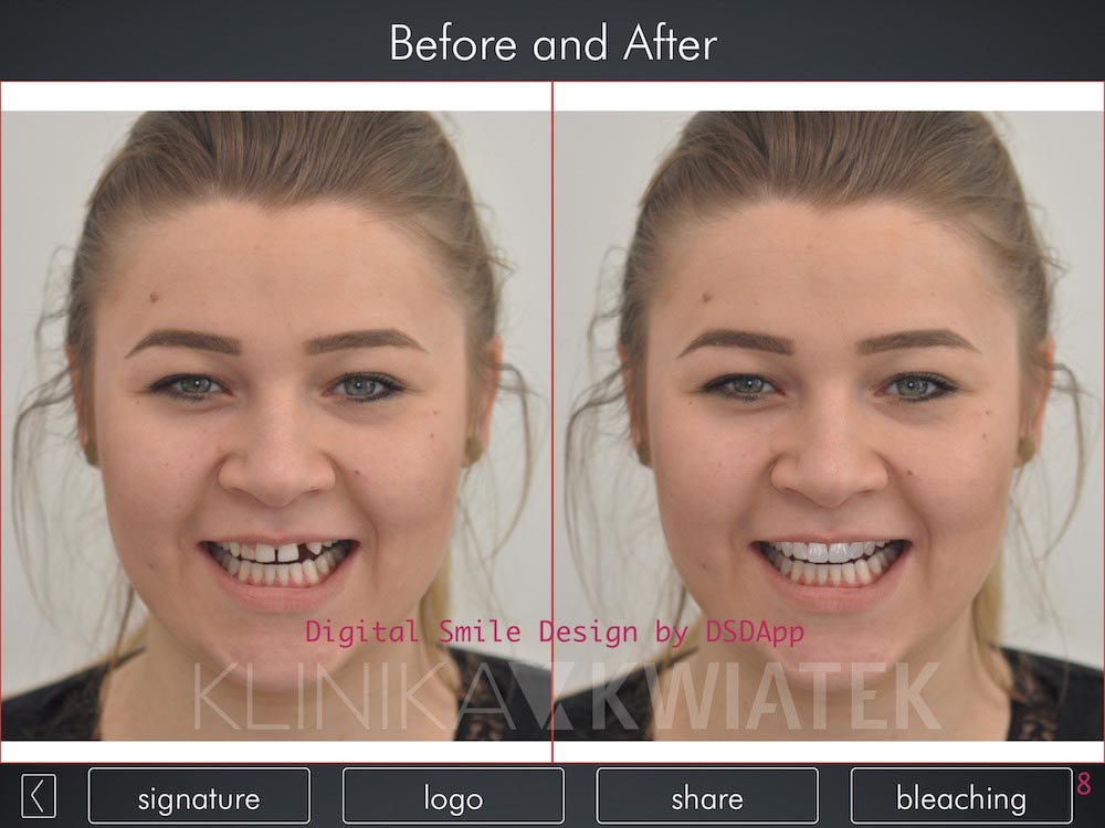 Effects of the prosthetist's work - photo before and after the procedure.