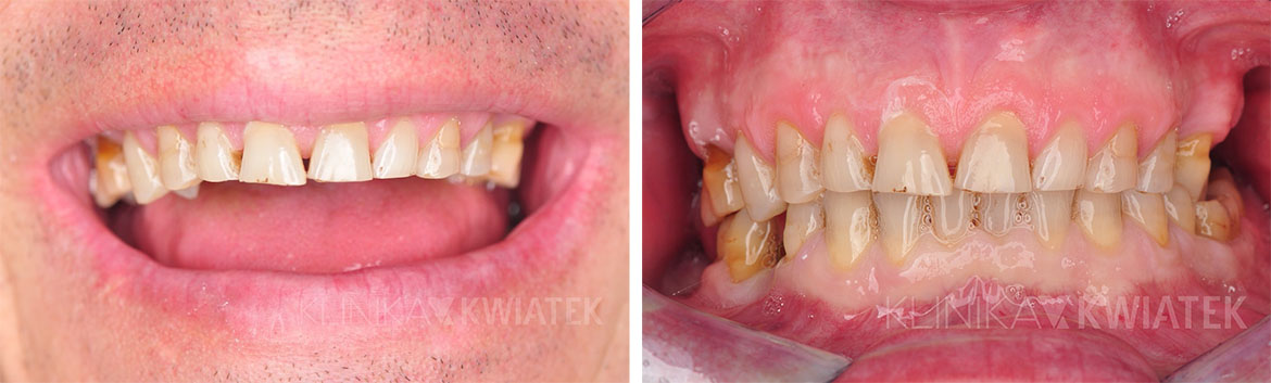 application of prosthetic crowns on a patient - before and after procedure photos - Kwiatek Clinic Poznań