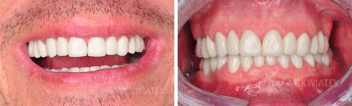 teeth before and after using the services of a prosthetist from Kwiatek Clinic in Poznan.