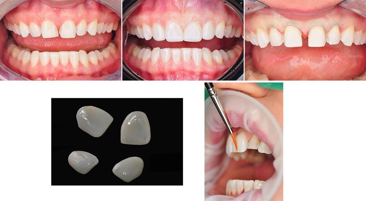 Veneers allow for easy correction of dental defects.