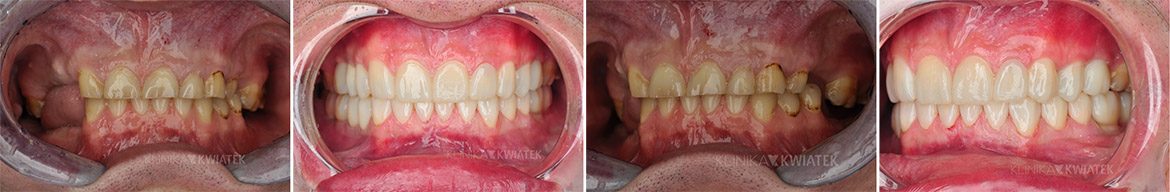 Patients before and after a complete bite reconstruction along with smile aesthetics improvement - Kwiatek Clinic Poznań