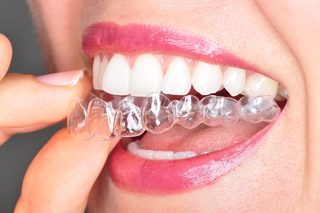 teeth whitening - a healthy smile as a result of tray whitening