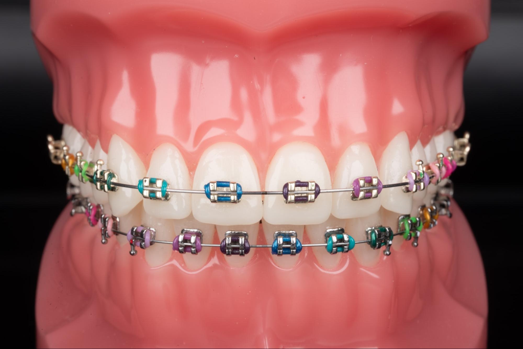 aparat stały estetyczny - rozwiązanie w leczeniu wad zgryzu