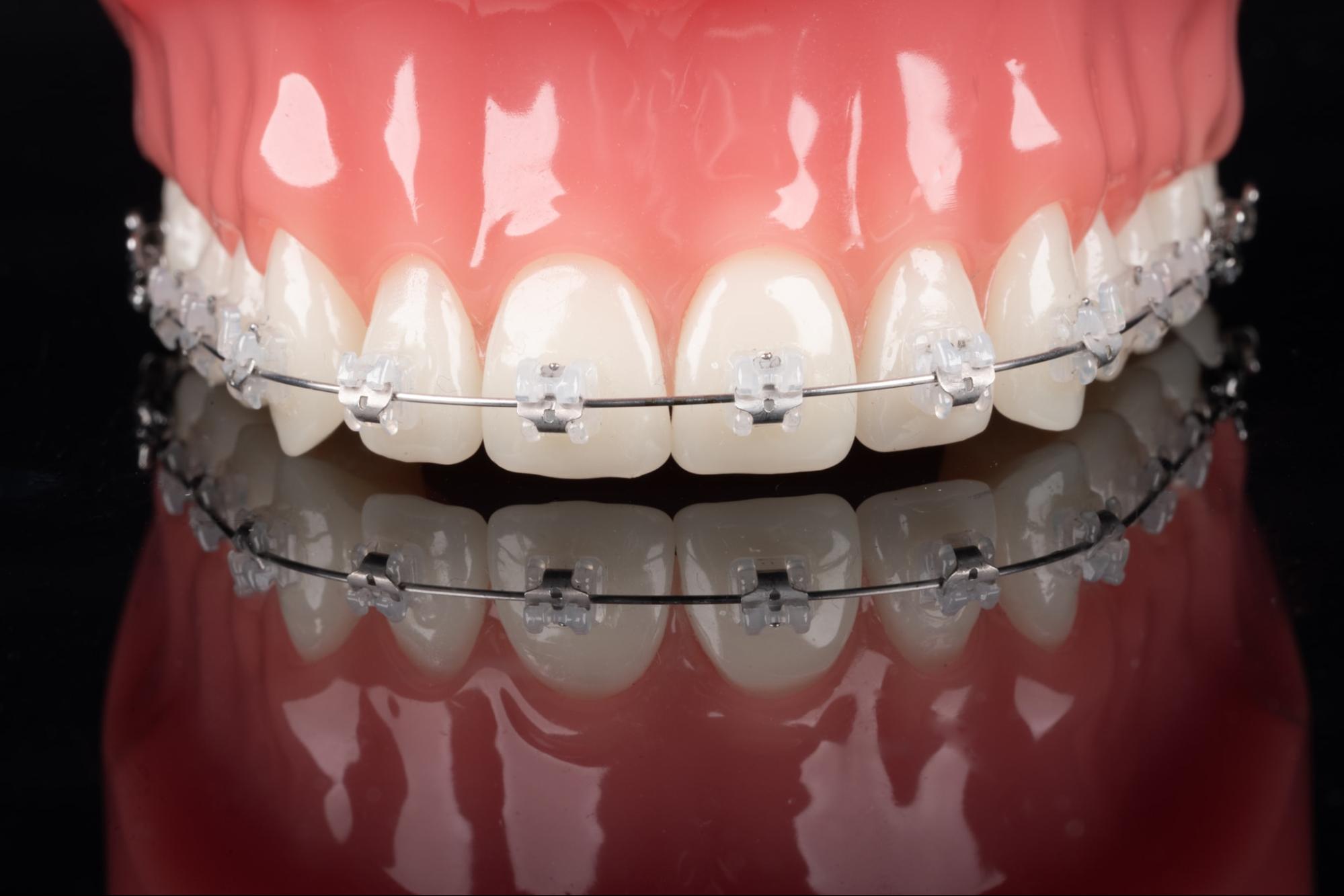 leczenie ortodontyczne - korygowanie wad zgryzu, aparat ceramiczny 