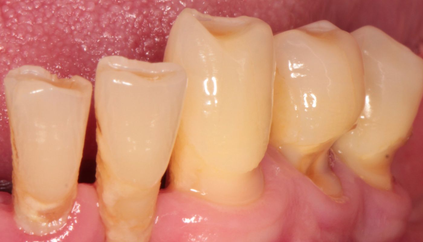 odsłonięte szyjki zębowe z płytką bakteryjną