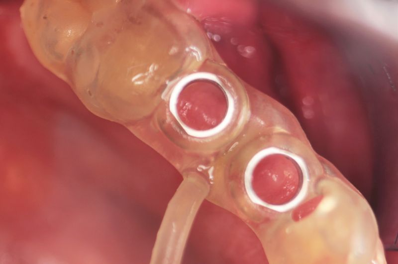 szablon implantologiczny przyłożony do dziąsła w miejsce gdzie będą umieszczane implanty zębów