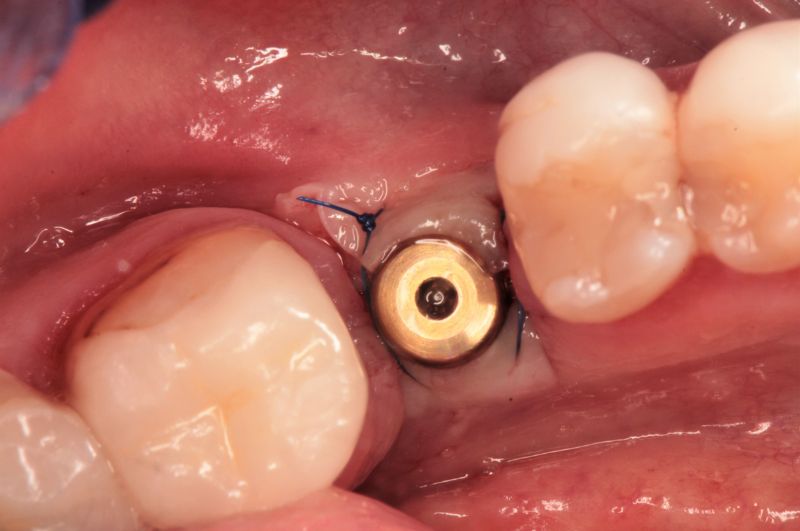 Wkręcenie śruby gojącej, czyli stan przejściowy zanim założony zostanie finalny implant zęba