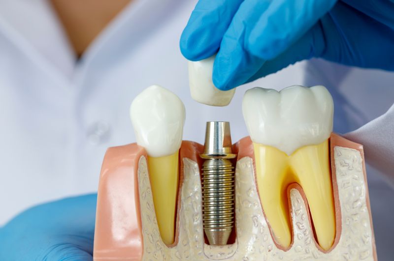 wszczepienie implantów zębów